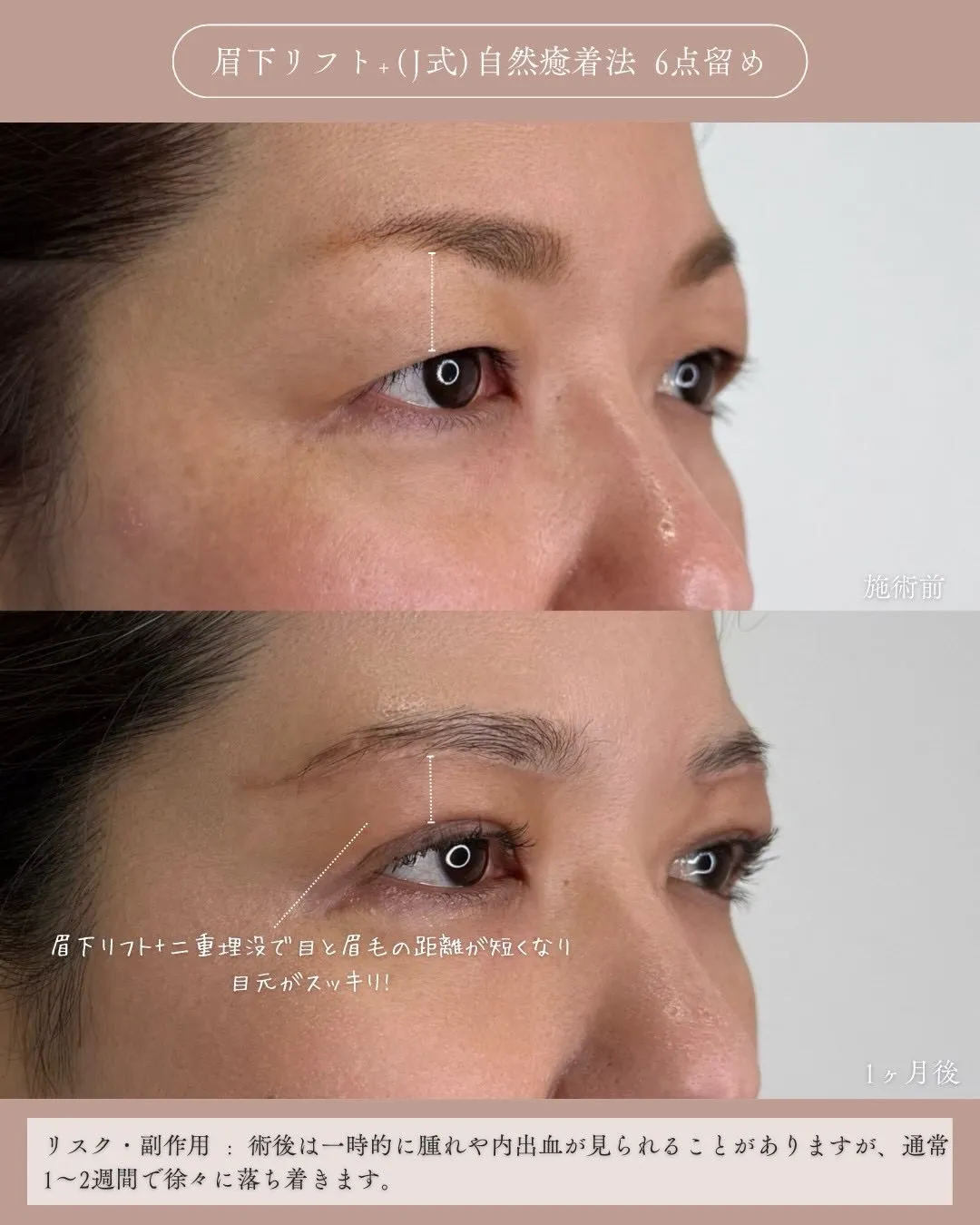 眉下リフト＋(Ｊ式)自然癒着法6点留め1_右斜め説明あり Before/After