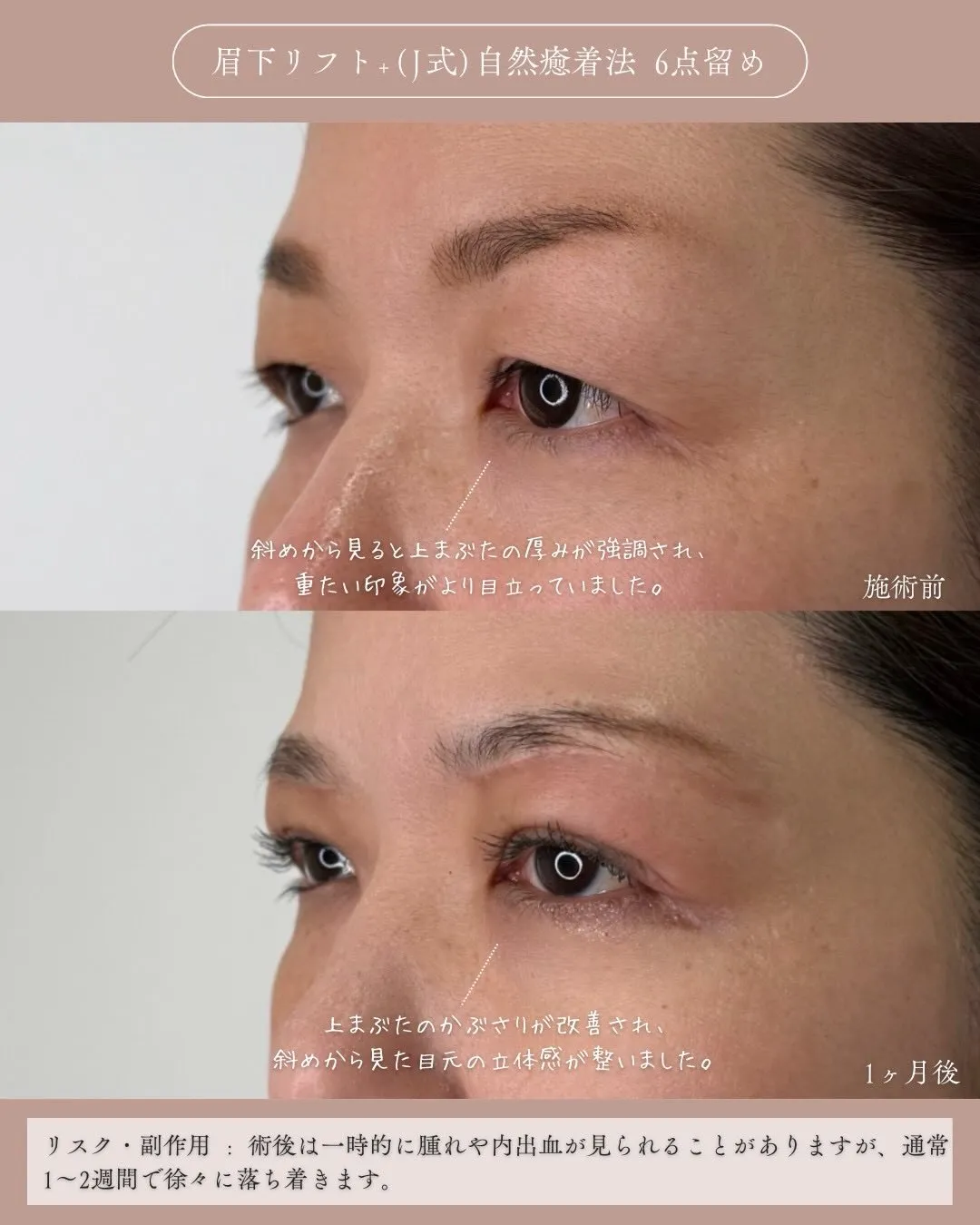 眉下リフト＋(Ｊ式)自然癒着法6点留め1_左斜め説明あり Before/After