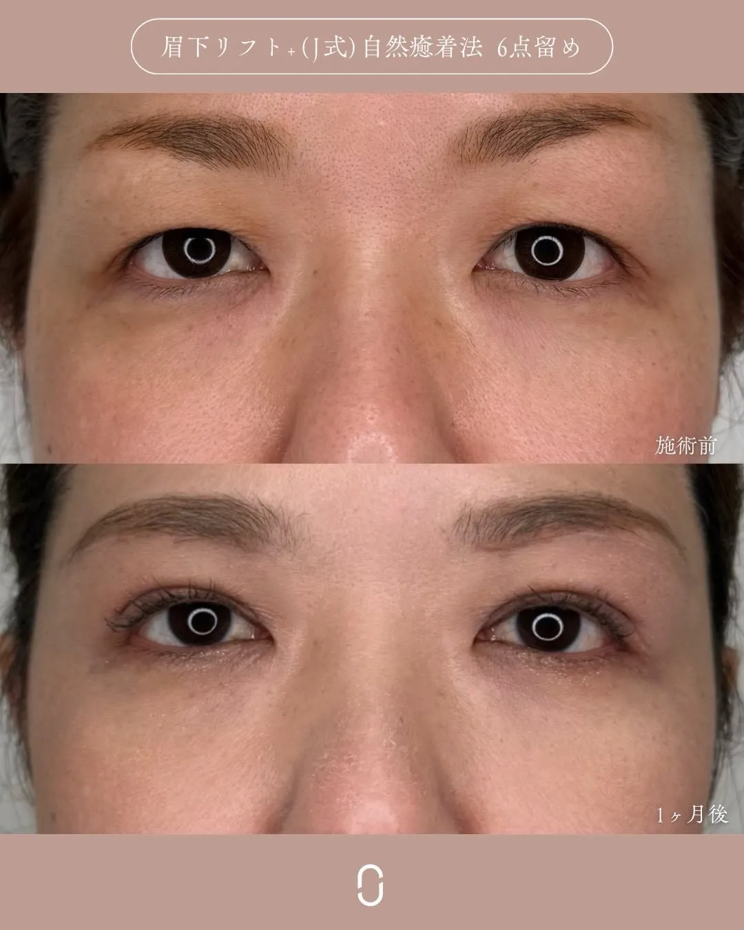 眉下リフト＋(Ｊ式)自然癒着法6点留め1_正面 Before/After
