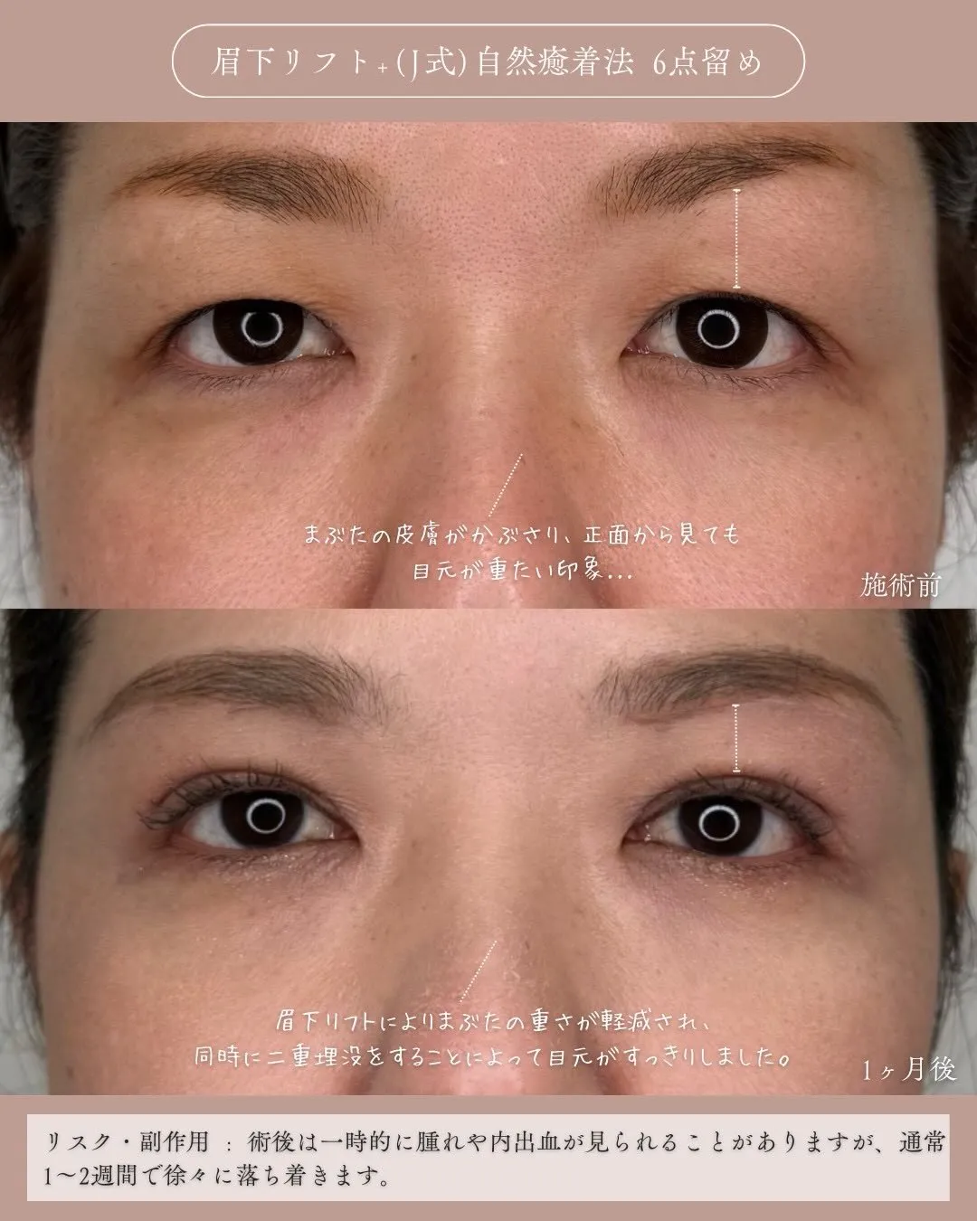 眉下リフト＋(Ｊ式)自然癒着法6点留め1_正面説明あり Before/After