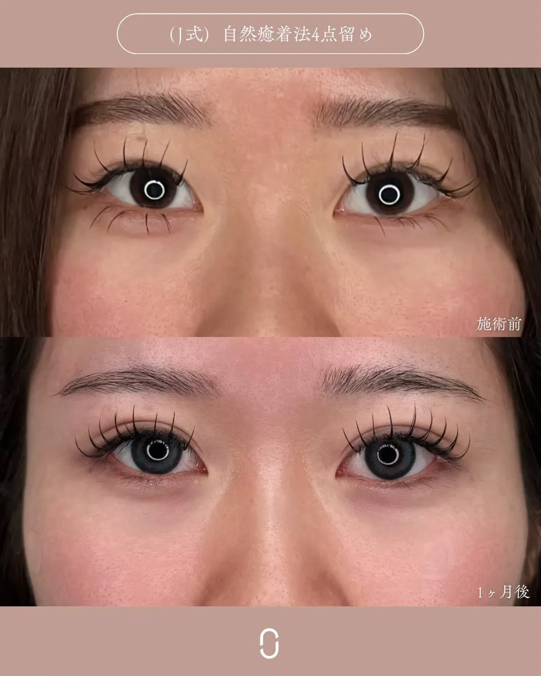 (Ｊ式)自然癒着法4点留め1_正面 Before/After
