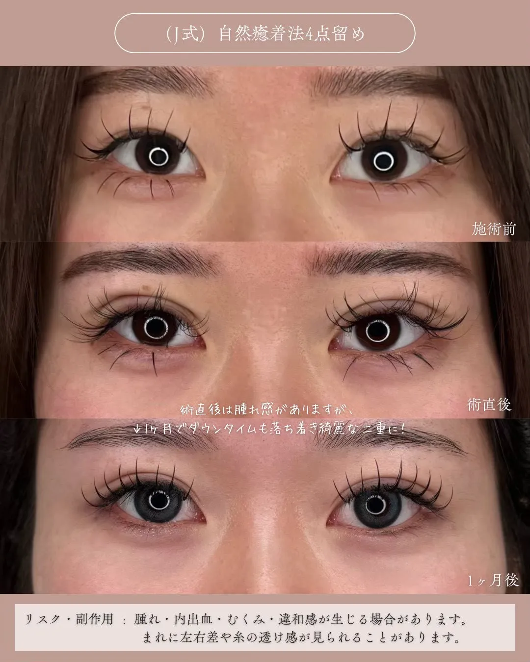 (Ｊ式)自然癒着法4点留め1_正面経過 Before/After