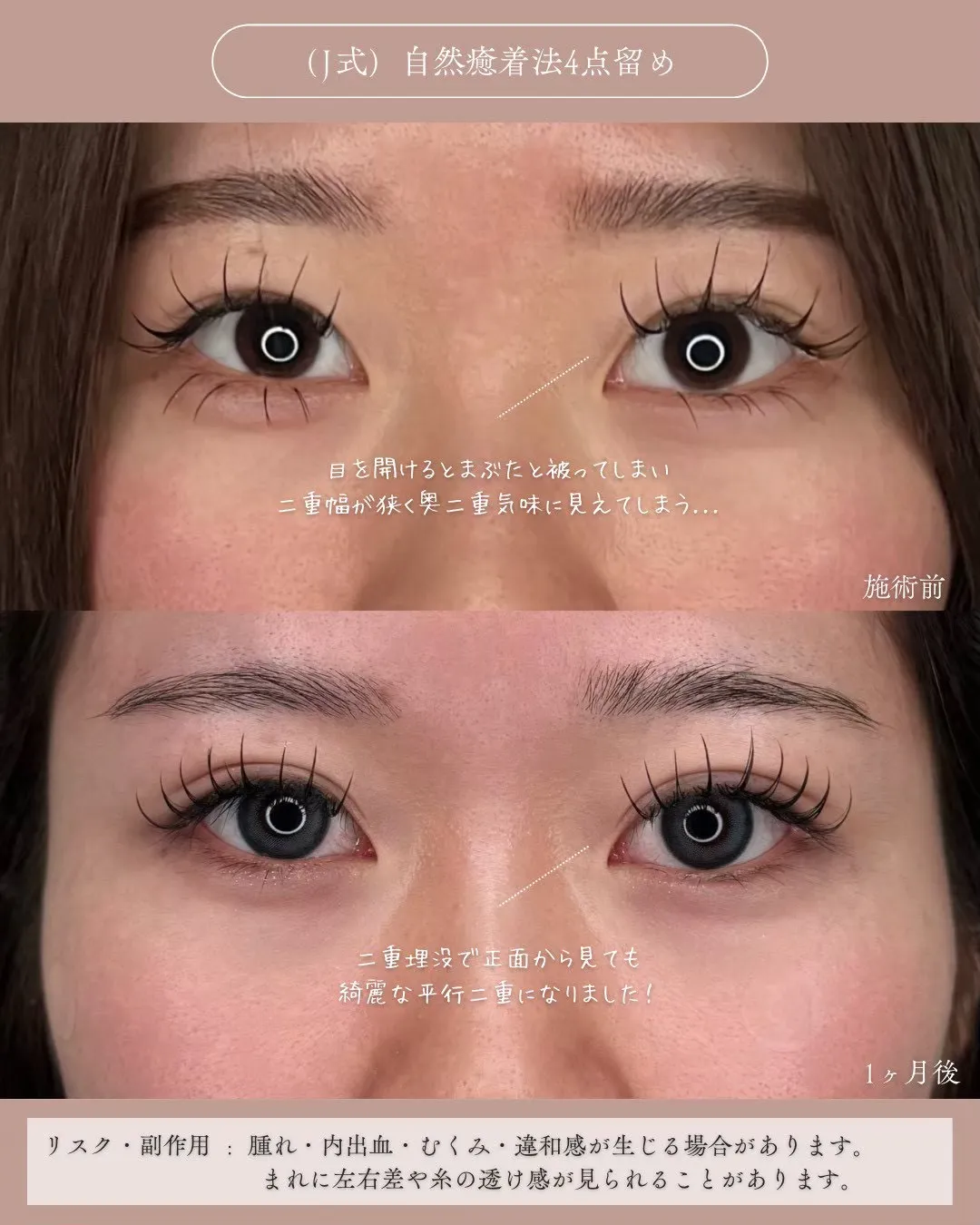 (Ｊ式)自然癒着法4点留め1_正面説明あり Before/After