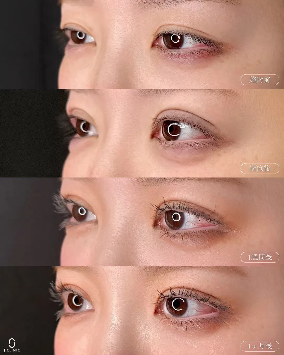 (Ｊ式)自然癒着法6点留め1_横経過 Before/After