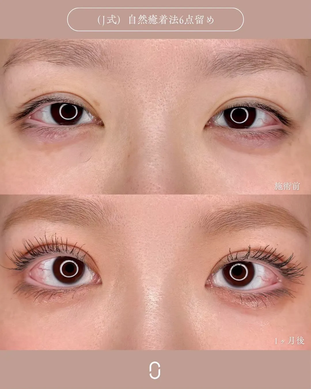 (Ｊ式)自然癒着法6点留め1_正面 Before/After