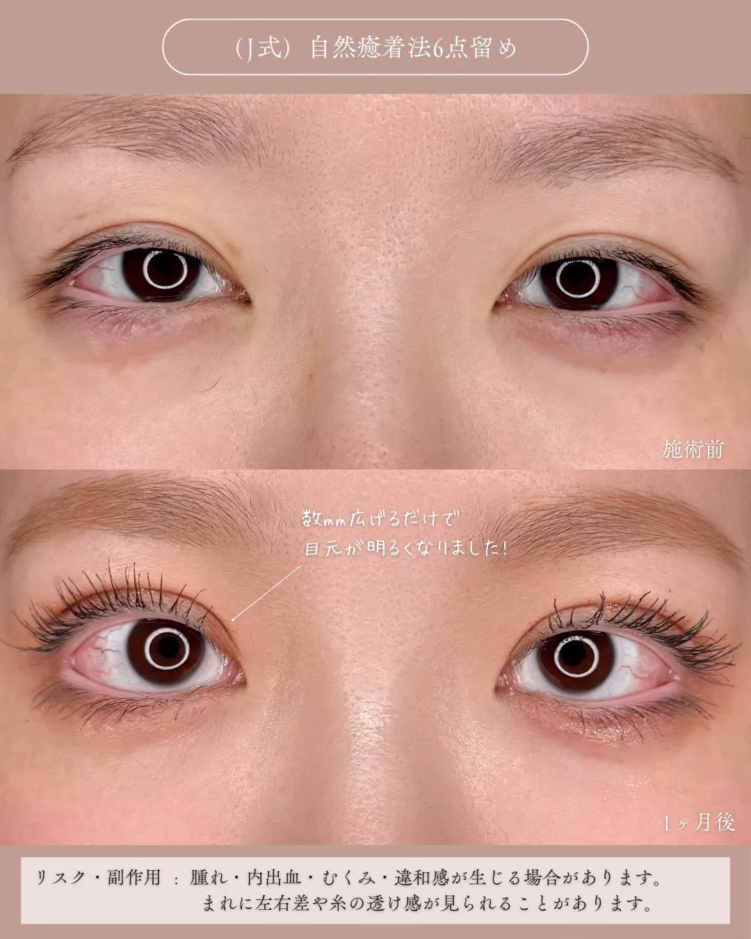 (Ｊ式)自然癒着法6点留め1_正面説明あり Before/After