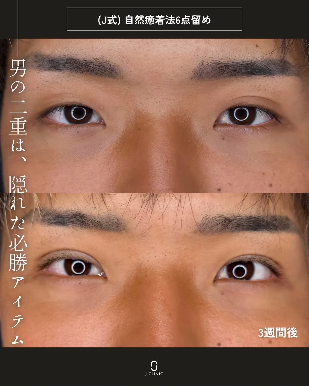 (Ｊ式)自然癒着法6点留め2_正面 Before/After