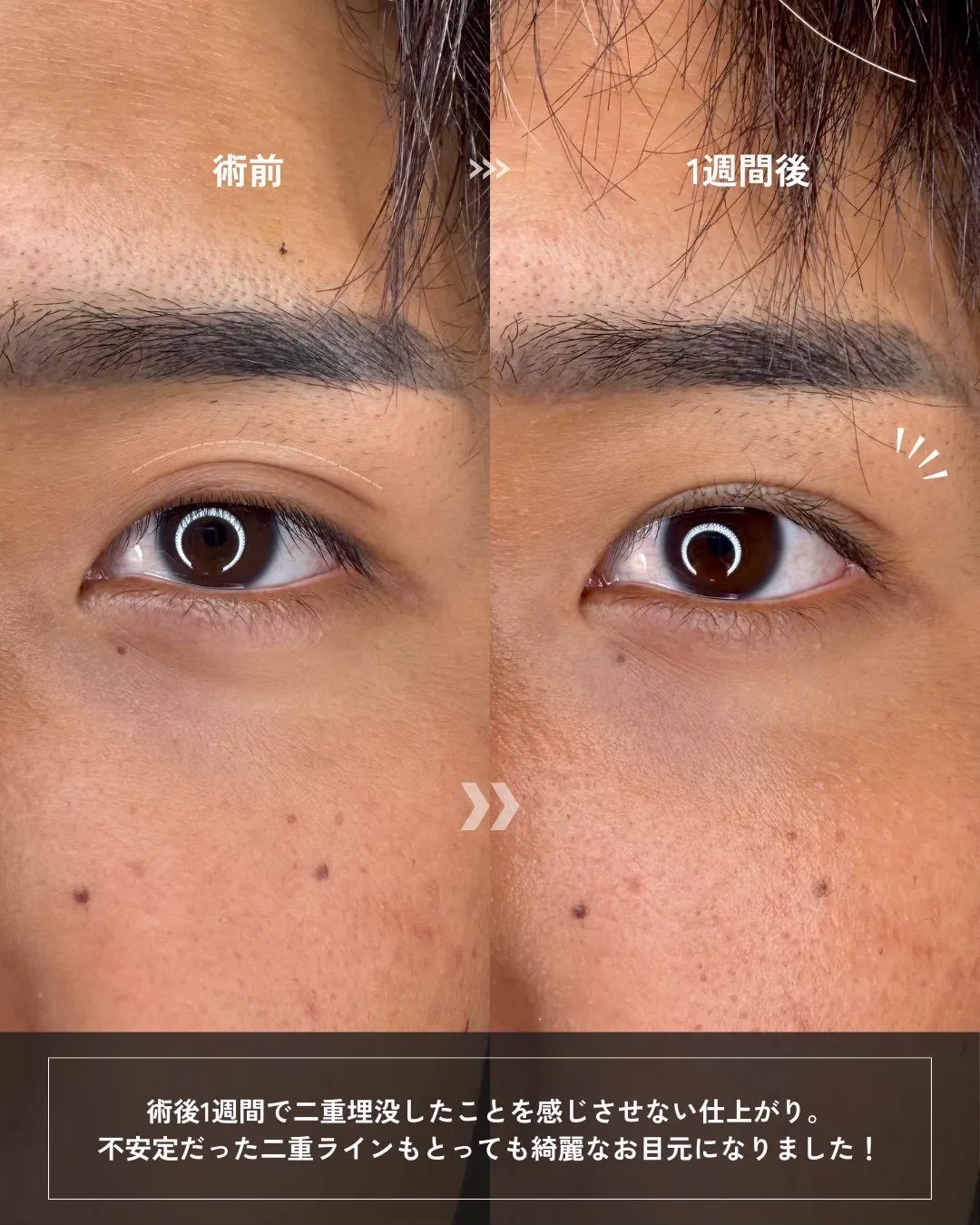 (Ｊ式)自然癒着法6点留め2_正面拡大 Before/After