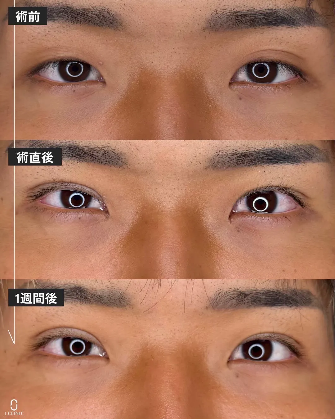 (Ｊ式)自然癒着法6点留め2_正面経過 Before/After