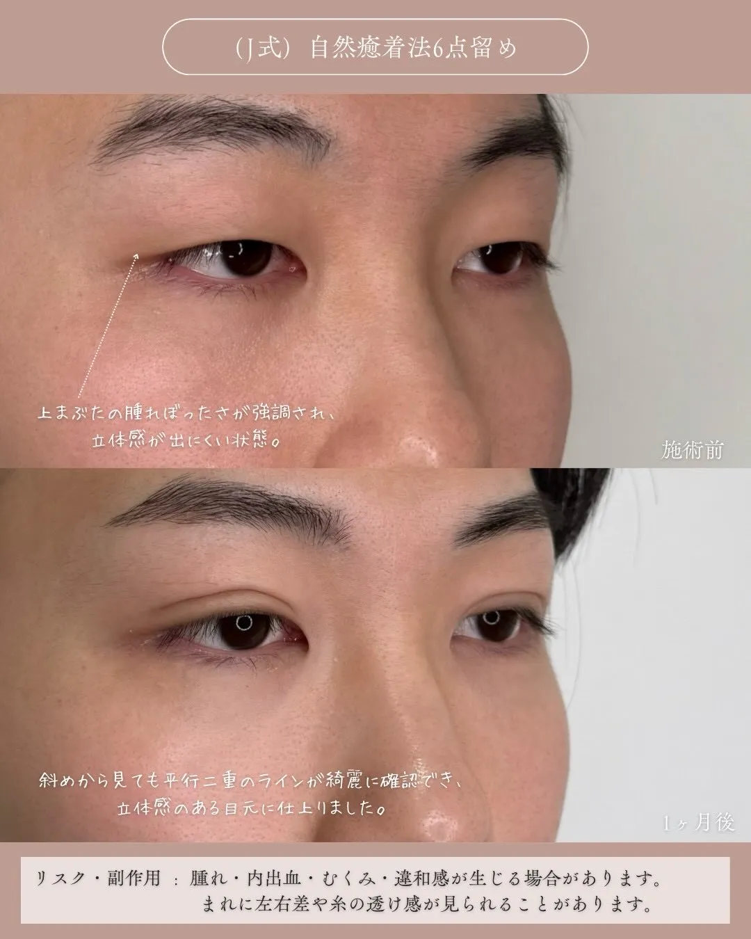 (Ｊ式)自然癒着法6点留め3_右斜め Before/After