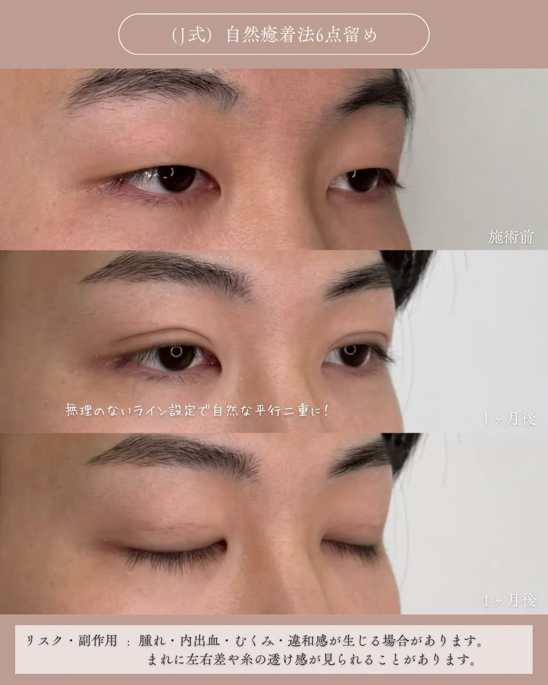 (Ｊ式)自然癒着法6点留め3_右斜め経過 Before/After
