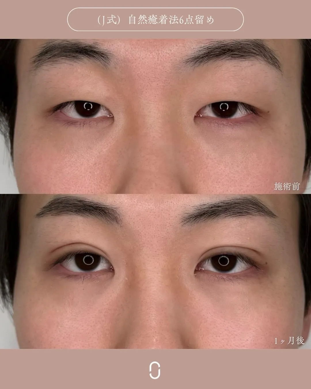 (Ｊ式)自然癒着法6点留め3_正面 Before/After