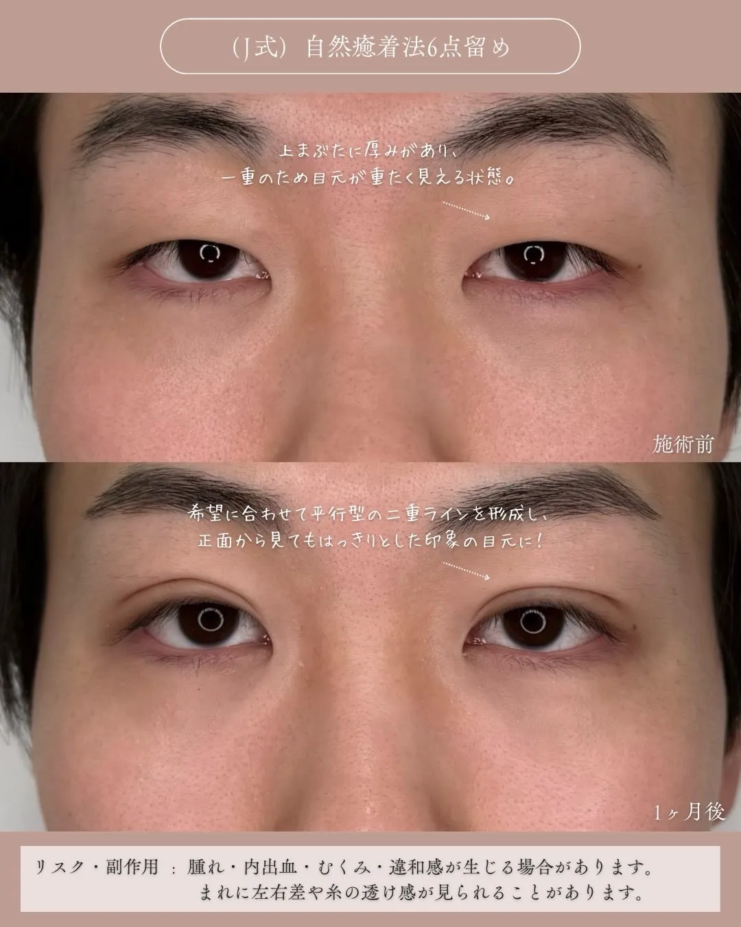 (Ｊ式)自然癒着法6点留め3_正面説明あり Before/After