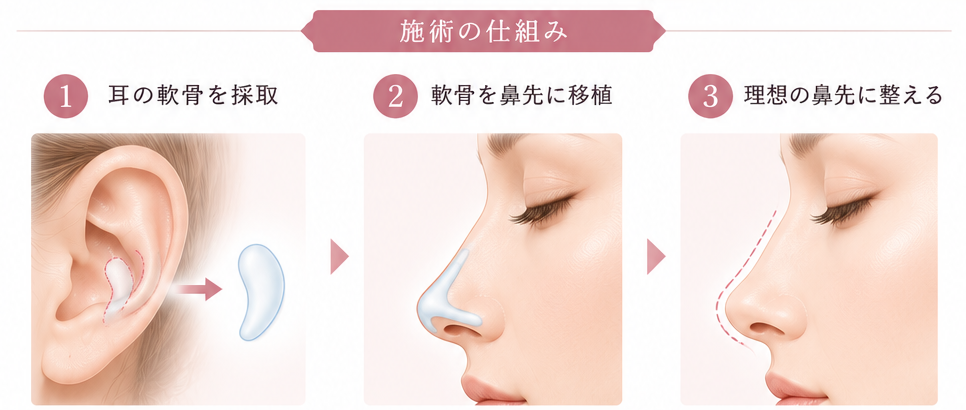 鼻尖形成（耳介軟骨移植）