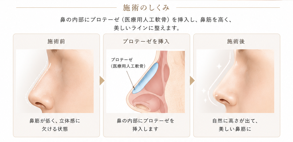 プロテーゼ概要